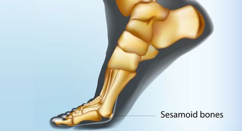 sesamoid bone foot, fracture, treatment, boca raton, florida Sesamoid Bone, Some People, How To Know, Bones, Quick Saves