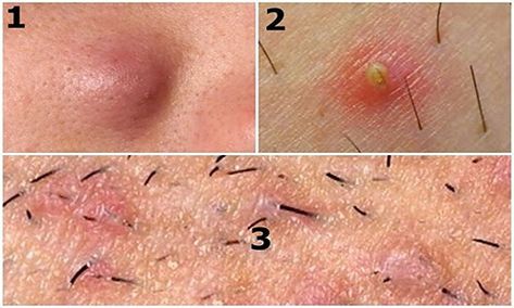 Ingrown Hair Under Armpit, Ingrown Hair Armpit, Infected Ingrown Hair, Ingrown Hair Serum, Ingrown Hair Remedies, Bump Hairstyles, Ingrown Hair Removal, Prevent Ingrown Hairs, Razor Bumps