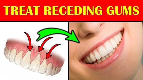 Are your gums receding? Have you tried every solution to help them regrow, but nothing has worked? Well, we have the answer! If you want to… Gums Receding, Reverse Receding Gums, Grow Back Receding Gums, Ways To Heal, Gum Recession, Dental Art, Health Heal, Receding Gums, Oil Pulling