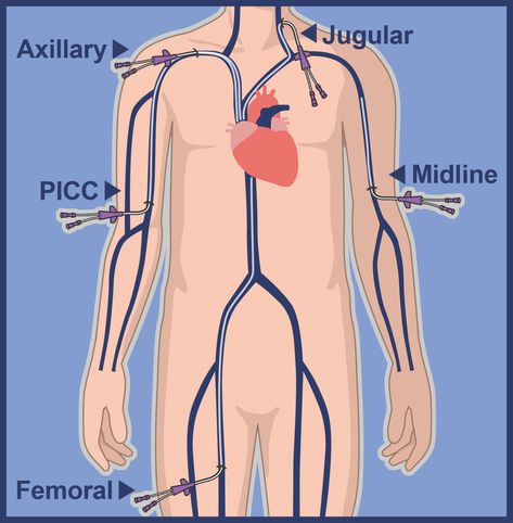 PICC Lines Overview Contact Center Customer Service, Nursing Iv, Central Venous Catheter, Iv Line, Vein Thrombosis, Central Line, Arteries And Veins, Iv Therapy, Care Hospital