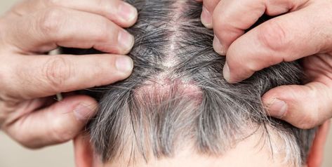 Scalp Psoriasis vs. Dandruff: How to Know What’s Causing Those White Flakes Scalp Scabs, Sores On Scalp, Scalp Acne, Head Louse, Itchy Scalp, Dry Scalp, Scalp Care, Hair Follicle, Dandruff