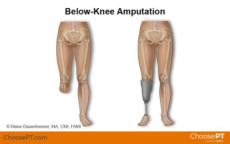 Below Knee Amputation, Below The Knee Amputation, Hoagie Sandwiches, Peg Leg, Home Tricks, Prosthetic Leg, Assistive Devices, Lower Extremity, Poor Circulation