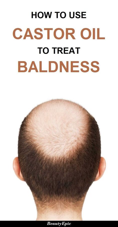 How to Treat Baldness with Castor Oil Hair Growth For Men, Castor Oil For Hair Growth, Castor Oil For Hair, Home Remedies For Hair, Baking Soda Shampoo, Hair Control, Hair Remedies, Hair Growth Oil, Hair Care Tips