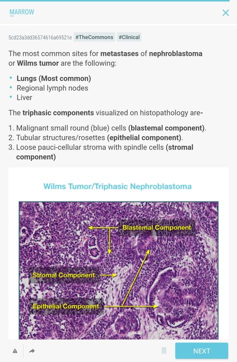 Wilms Tumor, Lymph Nodes, Thing 1