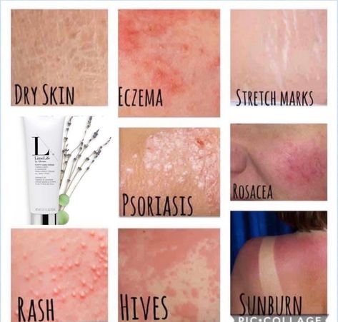 Skin Abnormalities, Skin Lesions, Skin Conditions Pictures, Skin Diseases Pictures, Skin Diseases Types Of, Thyroid Healing, Remove Skin Tags Naturally, Beauty Treatments Skin Care, Skin Moles