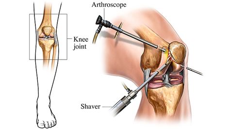 Orthopaedic Nursing, Arthroscopic Knee Surgery, Nursing Knowledge, Meniscal Tear, Knee Ligaments, Anterior Cruciate Ligament, Surgery Doctor, Ligament Tear, Ligament Injury