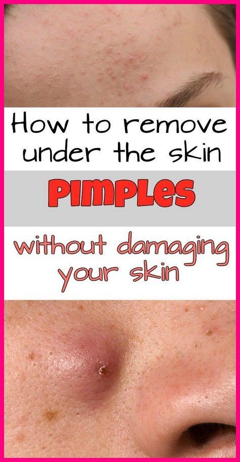 Under The Skin Pimples, Pimples Under The Skin, Under The Skin, How To Get Rid Of Pimples, Medicine Book, Acne Cream, Health Facts, Herbal Medicine, The Skin