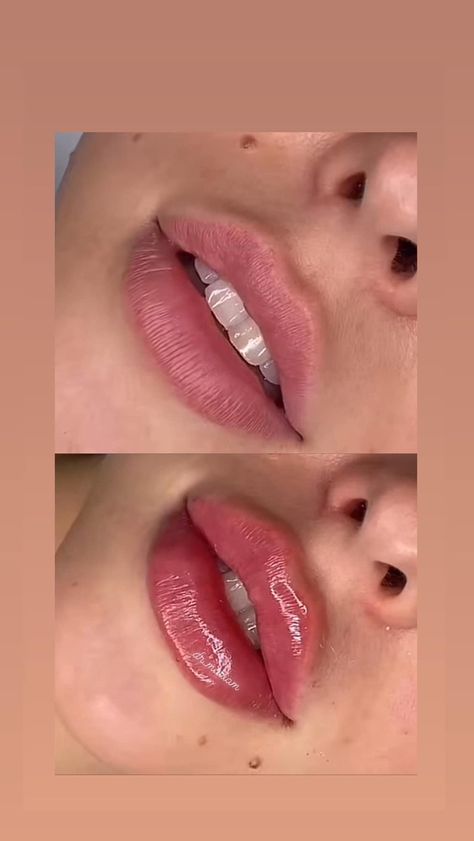 Lip Filler Round Lips, Lip Fillers Inspiration, Juvederm Before And After Lips, Natural Looking Lip Fillers, 1 Ml Lip Filler Before And After, Pouty Lip Filler, Fillers Before And After, Russian Lips Filler, 0.5 Ml Lip Filler Before And After