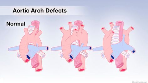 Transposition of the Great Arteries Stages Of Fetal Development, Aortic Arch, Congenital Heart Defect, Clogged Arteries, Heart Defect, Congenital Heart, Fetal Development, Cleanse Your Body, Cardiovascular Disease