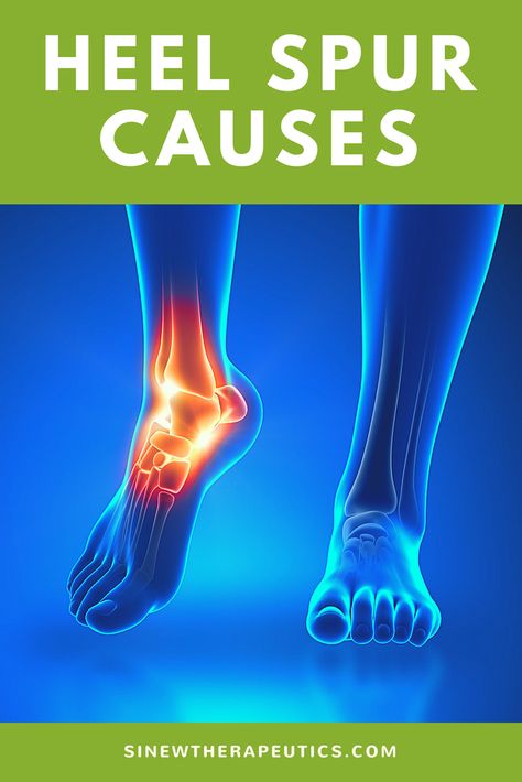 Bone Spur On Back Of Heel, Bone Spur Heel, Heal Pain Relief, Heel Spur Relief Remedies, Heal Spur Remedies, Heal Spurs, Heel Spur Relief, Sore Heels, Plantar Fascitis