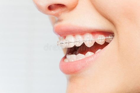 Braces Dentist, Ceramic Braces, Braces Cost, Invisalign Braces, Adult Braces, Getting Braces, Invisible Braces, Clear Braces, Dental Braces