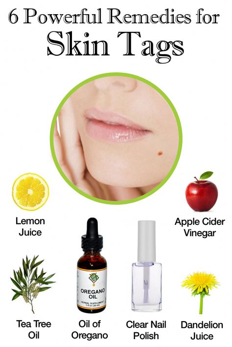 Learn how to naturally remove skin tags with these powerful home remedies. Some natural skin tag remedies include apple cider vinegar, lemon juice, and dandelion. Skin Tags Apple Cider Vinegar, Skin Tags On Face, Dandelion Oil, Remove Skin Tags, Apple Cider Vinegar For Skin, Remove Skin Tags Naturally, Toenail Fungus Remedies, Skin Growths, Skin Tags