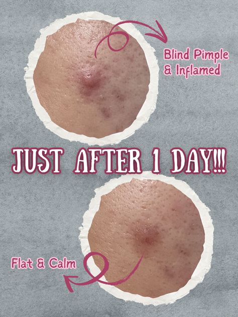 BLIND PIMPLES GONE OVERNIGHT!! Pimples Remove Tips, Hide Pimples With Makeup, Tips For Pimples, Pimples Skin Care, How To Hide Pimples, Mask For Pimples, Face Mask For Pimples, Pimple Solution, To Remove Pimples