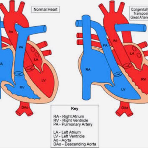 Congenitally Corrected Transposition of the Great Arteries (cctga) Transposition Of The Great Arteries, Coarctation Of The Aorta, Chd Heart, Heart Mum, Congenital Heart Defect Awareness, Nurse Teaching, Nursing Mnemonics, Chd Awareness, Normal Heart