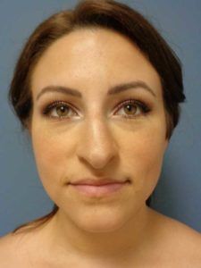 Bulbous Nose Rhinoplasty Before After, Rhinoplasty Before After, Nose Plastic Surgery, Celebrity Surgery, Bulbous Nose, Korean Plastic Surgery, Rhinoplasty Surgery, Rhinoplasty Before And After, Rhinoplasty Nose Jobs