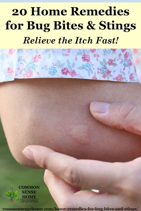 Mosquito Bite Itch Relief, Remedies For Bug Bites, Bug Bite Itch Relief, Wasp Sting Remedy, Mosquito Bite Relief, Bug Bite Itch, Mosquito Bite Itch, Itchy Bug Bites, Remedies For Mosquito Bites