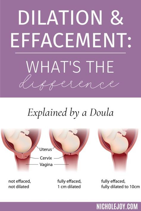 As you near the end of your pregnancy, you may start to hear the words dilation and effacement from your provider. Still a little confused about what’s what? I’ll break it down for ya. How To Check Cervix Dilation, Dilation Exercises, Cervical Effacement, Dilation And Effacement, Labor Preparation, Cervix Dilation, Labor Pain Management, Labor Tips, Birth Tips