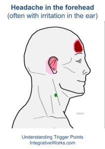 fi-headache-in-the-forehead-with-ear-irritation Acupressure Headache, Forward Head Posture Exercises, Acupuncture Benefits, Ear Ache, Neck And Shoulder Muscles, Forward Head Posture, Trigger Point Therapy, Posture Exercises, Headache Relief