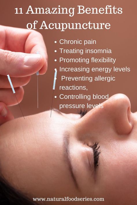 Benefits of Acupuncture includes treating pregnancy stress, treating Parkinson’s disease, promoting recovery in chemotherapy, for headache and migraine, preventing chronic pain. check out more amazing benefits of acupuncture. #acupuncture #acupuncturebenfits #acupunctureuses Energetic Body, Organic Foods, Increase Energy Levels, Mental Energy, Mood Enhancers, Natural Therapy, Chronic Condition, Holistic Healing, Health Lifestyle