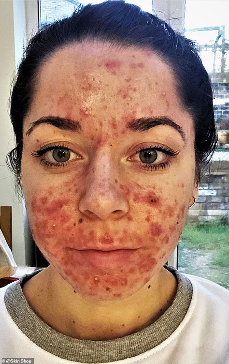 Personal trainer who had the 'worst acne ever seen' shares her striking before and after pictures Acne Pictures, Before And After Acne, Blind Pimple, Forehead Acne, Pimples Under The Skin, Bad Acne, Natural Acne Remedies, Severe Acne, Body Acne