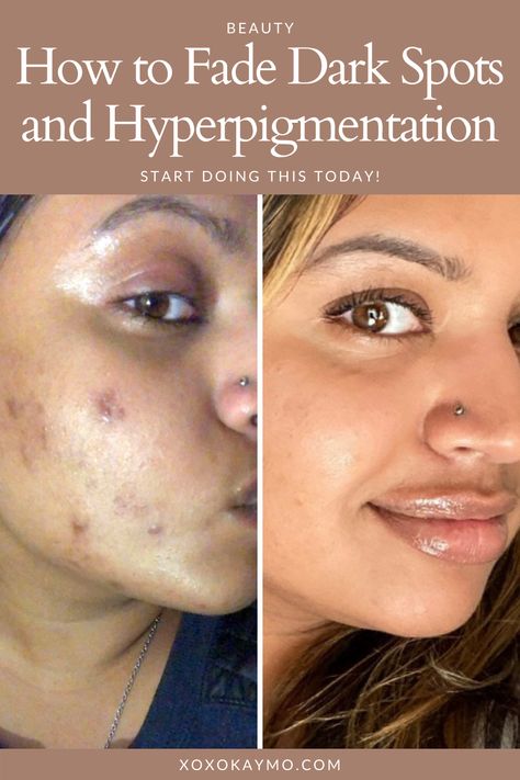 How to Fade Dark Spots and Hyperpigmentation Acne happens, and sometimes we have the scars left over to prove it. If you have darker skin tones, acne blemishes tend to linger long after the pimple disappears. There are products and methods you can implement today to get rid of these dark spots and hyperpigmentation quick. Skin Blemishes How To Get Rid, How To Get Rid Of Acne And Dark Spots, How To Remove Blemishes From Face, Hyper Pigmentation On Face, Best Skin Care Products For Acne Dark Spots, Pimple Scar Removal Dark Spots, Dark Acne Spots Remedies, How To Remove Hyperpigmentation On Face, Blemishes On Face Remedies