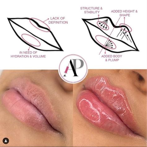 Dermal Fillers Lips, Facial Injections, Lip Permanent Makeup, Pdo Threads, Lips Inspiration, Aesthetic Dermatology, Nurse Injector, Aesthetic Nurse, Audrey Rose