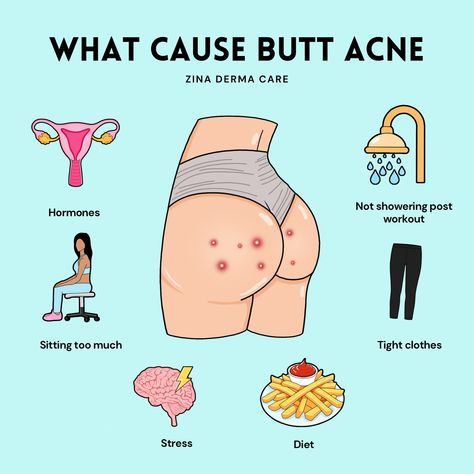 🍑 What’s causing that butt acne? 🍑 Let’s be real, it happens! Here are some sneaky reasons why: • Hormones (because, of course 🙄) • Skipping that post-workout shower 🚿 • Sitting too much (especially if you’re glued to your work chair all day) 💻 • Wearing tight clothes that don’t let your skin breathe 👖 • Stress (thanks, deadlines! 😅) • Diet (maybe less junk food, more water?) Tip: Shower right after a workout and take breaks from sitting all day to let your skin breathe. 🌬️ If butt ... What Causes Acne, Green Tea Benefits Health, Black Skincare, Physiological Facts, Body Wisdom, Teen Trends, Black Skin Care, Quick Makeup, Perfect Skin Care Routine