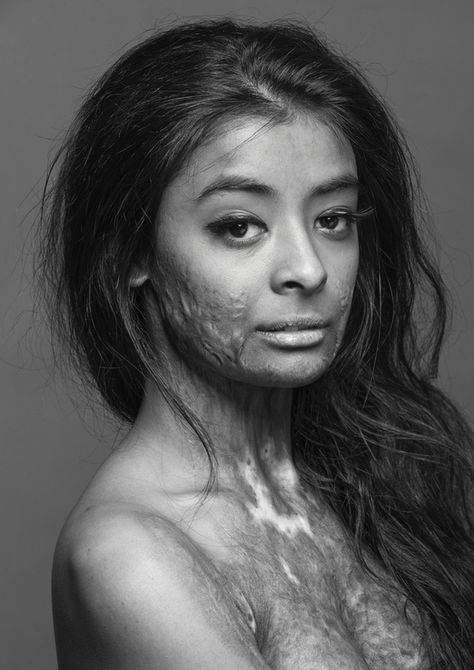 This beautiful model, a burn survivor, did this photo shoot to, in her own words, "prove that scars do not change a person, they make that person who they become." Warrior Women, Story Board, We Are The World, People Of The World, Interesting Faces, Inspirational People, Look At You, Inspirational Women, People Around The World