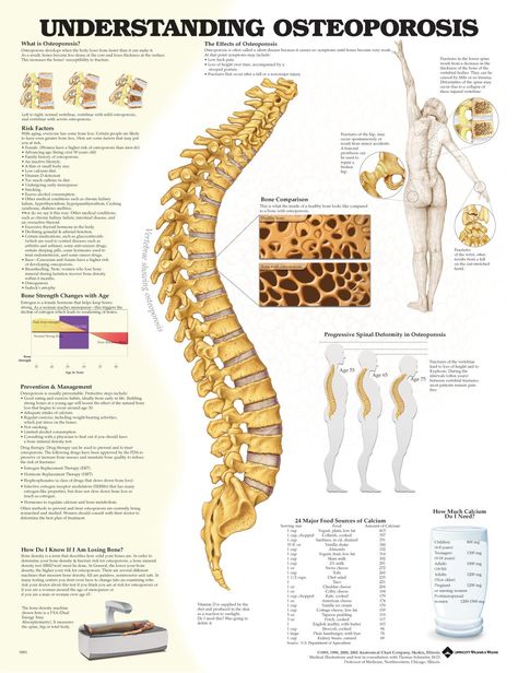 . Autoimmune Disease Awareness, Scientific Poster Design, Low Bone Density, Scientific Poster, Prevention Month, Penyakit Jantung, Bone Fracture, Medical Posters, Spine Surgery