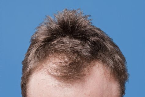 Hairstyles For Front Thinning Hair, Thinning Hair Hairstyles, Hair Fall Reasons, Hair Fall Men, Alopecia Causes, Causes Of Hair Fall, Curly Hairstyles For Men, Losing Hair, Short Curly Hairstyles