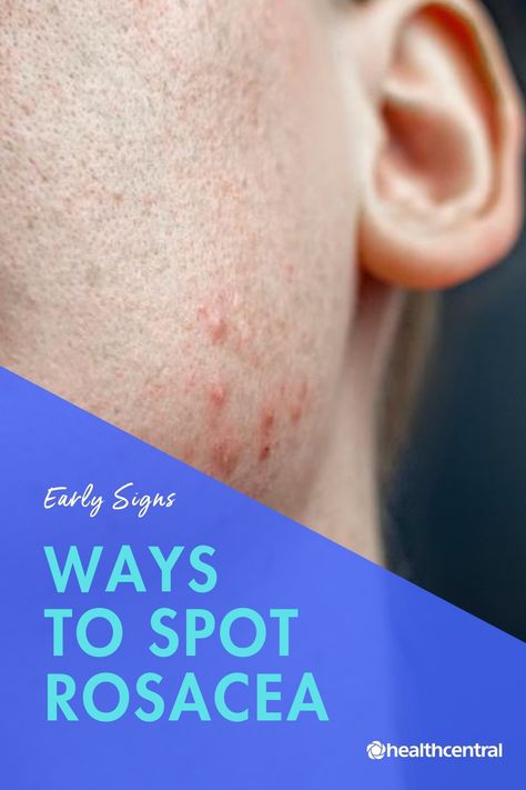 Red Bumps On Face, Redness Remedy, Home Remedies For Face, Rash On Face, Warts Remedy, Itchy Face, Acne Redness, Pimples Under The Skin, Skincare Acne