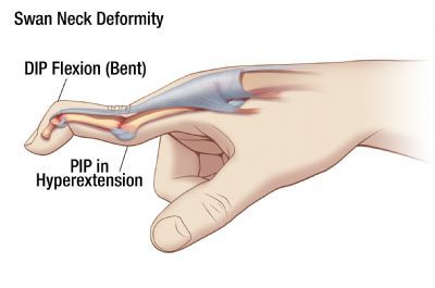 Swan Neck Deformity | Oh My Arthritis Medical Vocabulary, Ankle Anatomy, Physical Therapy Assistant, Fine Motor Activities For Kids, Trigger Finger, Swan Neck, Hand Therapy, Ehlers Danlos Syndrome, Anatomy Study