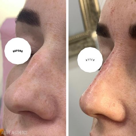 Nose Hump Aesthetic, Nose Filler, Nose Fillers, Natural Face Cleanser, Baby Feeding Schedule, Notting Hill London, Big Noses, Nose Job, Notting Hill