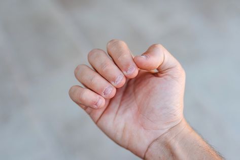 Hope for Nail Biters? Can Bitten Nails Grow Back To Normal? Grow Out Nails, Bitten Nails Before And After, Short Bitten Nails, Biting Fingernails, Bitten Nails, Nail Biting Habit, Ingrown Nail, How To Grow Nails, Fun Nail Colors