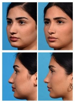 Nose Job Tip Reduction, Rhinoplasty Before And After Bulbous, Nose Job Before And After Front View, Nose Job Front Profile, Nose Inspo Front View, Nose Job Inspiration Front View, Straight Nose Front View, Nose Job Inspo Front View, Subtle Nose Job