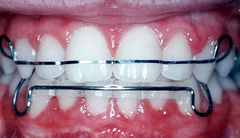 Some easy tips – that you don't know can help to keep your straight right at the position. Hawley Retainer, Dentist Aesthetic, Teeth Straight, Braces Retainer, Jewelry Teeth, Braces Colors Ideas, Removable Braces, Straighten Teeth, Retainer Teeth