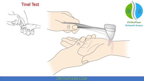 Tinel Test for Nerves Evaluation Tarsal Tunnel, Nerve Conduction Study, Median Nerve, Orthopedic Surgery, Carpal Tunnel, Sports Medicine, Nerve, Pediatrics