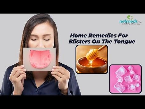 Discover effective home remedies to alleviate discomfort caused by tongue sores and blisters. Learn how to treat and soothe inflamed mouth sores for relief from pain and discomfort. Know more! Mouth Blister Remedy, Blister On Tongue, Blister In Mouth, Mouth Blisters, Blister On Lip, Tongue Sores, The Tongue, Home Remedies, Medicine