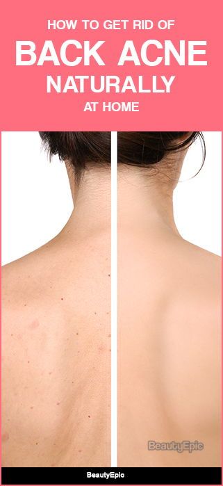 If you are victim of back acne, we brought you some solution to solve them all with herbal remedies. Let us read to know some effective ways on how to get rid of back acne naturally. Back Acne Remedies Diy, Get Rid Of Back Acne, Rid Of Back Acne, Back Acne Remedies, Back Acne, Pimples Under The Skin, Pimples Overnight, Natural Acne Remedies, Natural Acne