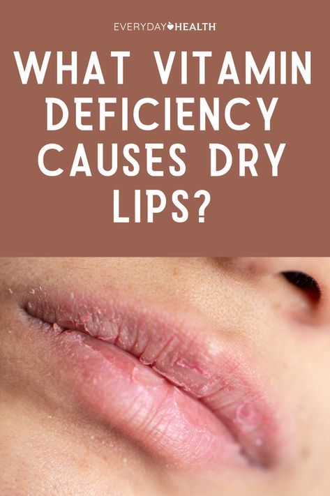 3 Vitamin and Nutrient Deficiencies That Can Cause Dry Lips If lip balm and other at-home treatments don't provide relief for dry lips, you may have a nutrient deficiency. Who hasn’t experienced dry lips on occasion? Typically, you can use lip balm to soothe and soften your lips once again. But if the usual remedies for chapped lips don’t get rid of the problem, a nutrient deficiency may be the cause. Dry Chapped Lips Remedy, Remedy For Dry Lips, Lip Therapy For Dry Lips, The Best Lip Balm, Dry Lips Tips, Dry Lips Causes, Lip Lines Get Rid Of, Dry Mouth Remedies How To Get Rid, Chapped Lips Remedy Severe