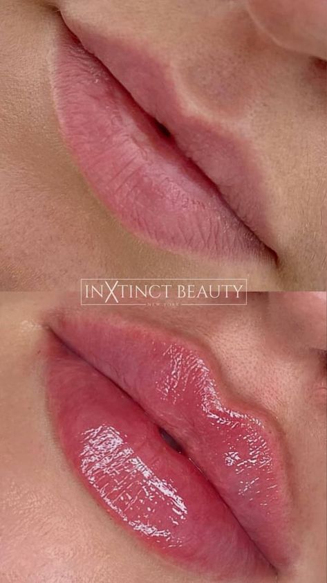 Russian Lip Technique - Lip Augmentation, Lip Filler NYC Russian Lips Filler 1ml, Lip Injections Aesthetic, Natural Lip Fillers 0.5ml, 1 Ml Lip Filler Before And After, Lip Filler Styles, Russian Lip Filler Technique, Lip Filler Natural, 0.5 Ml Lip Filler Before And After, Russian Lips Filler