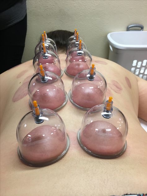 Hijama Cupping Therapy, Foot Massage Techniques, Benefits Of Cupping, Hijama Cupping, Massage Pictures, Cupping Massage, Face Mask Aesthetic, Spa Room Decor, Reflexology Massage