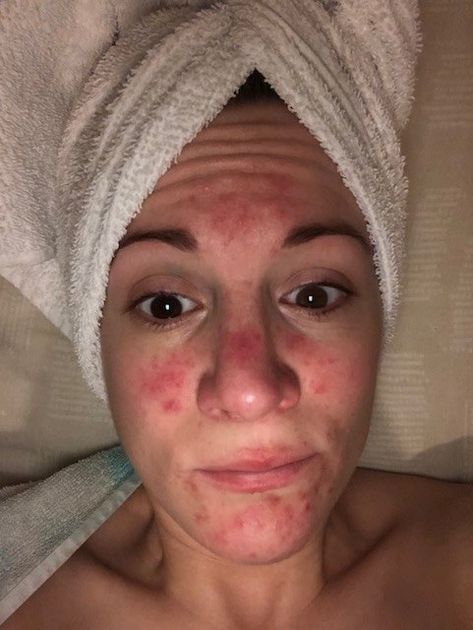 11 People Describe What It's Really Like to Have Rosacea | SELF Red Bumps On Face, Sunburn Face, Get Rid Of Sunburn, Severe Sunburn, Skin Condition, Skin Conditions, Essential Oil Blends, Bump, Home Remedies