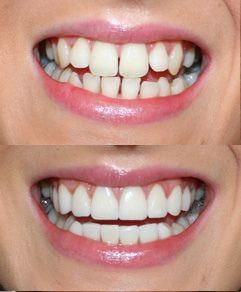 Gaps In Teeth, Braces Transformation, Dentist Aesthetic, Teeth Makeover, Teeth Repair, Teeth Eruption, Dental Ceramics, Pretty Teeth, Tooth Repair