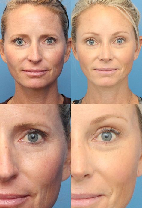 Temporal Brow Lift, Endoscopic Brow Lift Before And After, Eye Brow Lift Before And After, Brow Lift Botox Before And After, Eyebrow Lift Before And After, Brow Lift Botox Eyebrows, Upper Blephoraplasty Before And After, Botox Eyebrow Lift Before And After, Brow Lift Before And After