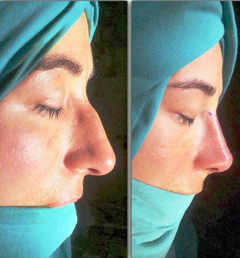 Nose Job Before And After Bump, Turkey Nose Job Before And After, Rynoplasty Surgery, Turkey Nose Job, Nose Job Before And After, Nose Bump, Before And After Nose Job, Pimple Inside Nose, Acne On Nose