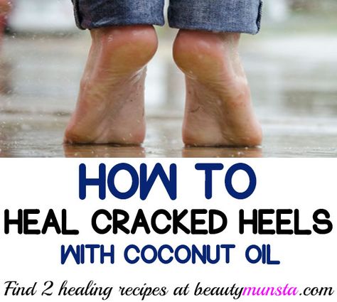 Find out how to use coconut oil for cracked heels in this post! Your feet are one of the most overworked limbs of your body. Genetics, age, dehydration, Coconut Oil For Feet Dry Skin, Cracked Heels Diy, Dry Feet Remedies, Heal Cracked Heels, Homemade Foot Scrub, Homemade Foot Soaks, Beauty Tips In Hindi, Best Coconut Oil, Coconut Bath