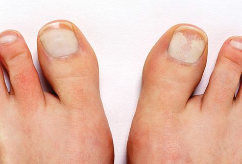 Pictures of Toenail Colors and What They Mean White On Toenails, How To Whiten Toenails, White Patches On Toenails, Toenail Whitening, White Spots On Toenails, Toenail Color, White Toenail, Brittle Toenails, Toenail Colors