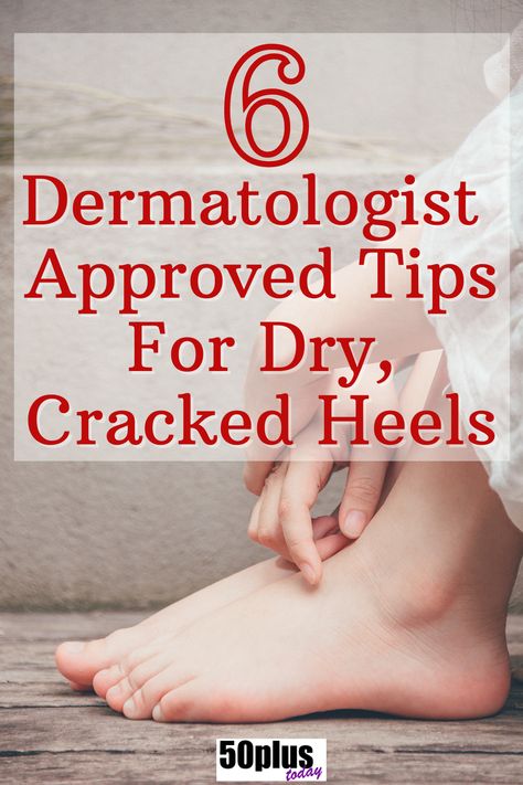 Hate dry cracked heels? Here's how to heal them and in the future - prevent them! Dermatologist recommended. #dermatologist #skincare #winterskin #crackedheels #drycrackedheels #50plus #seniors #uglyfeet Dry Cracked Feet Home Remedy, How To Get Smooth Heels, Cracked Feet Remedies Heels, How To Remove Dry Skin From Heels, Soft Heels Remedies, How To Get Rid Of Dry Feet Skin, How To Soften Heels, How To Get Rid Of Rough Heels, Heel Softener Remedies