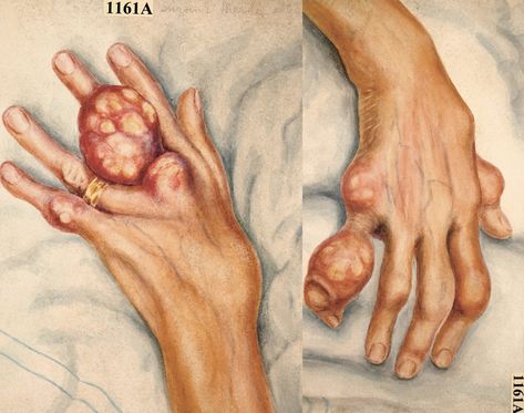 Sick Rose: Watercolour drawing of the hands of a sixty-three year old woman suffering from chronic gout The Sick Rose, Medical Drawings, Medical Textbooks, Skin Drawing, Oldest Human, Digital Museum, Medical Art, Natural Pain Relief, Old Hands